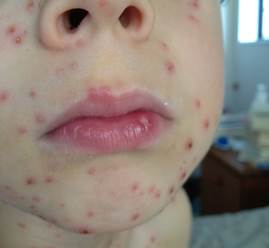 Rubella Test: At a Glance | Rubella Test: German Measles ...