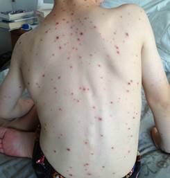 Chickenpox | kidshealth