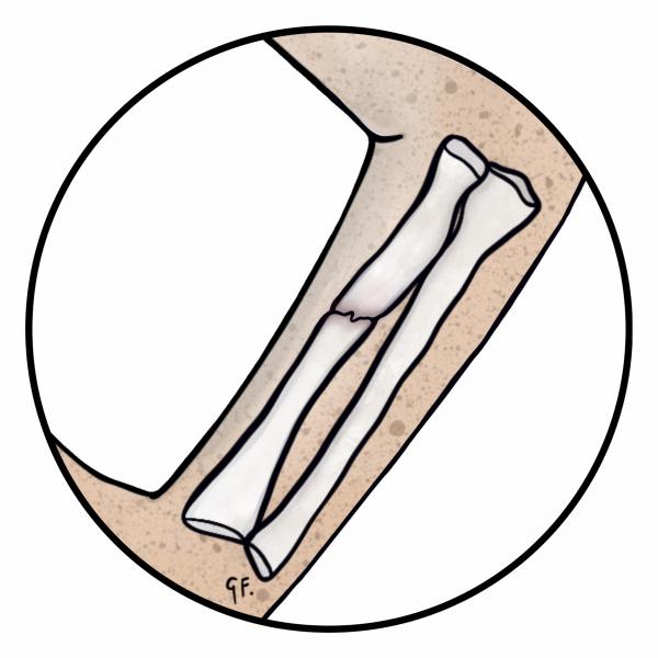 Illustration of a closed fracture of the arm