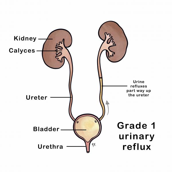 A diagram of the kidney showing grade 1 reflux