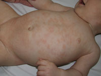Infant Atopic Dermatitis