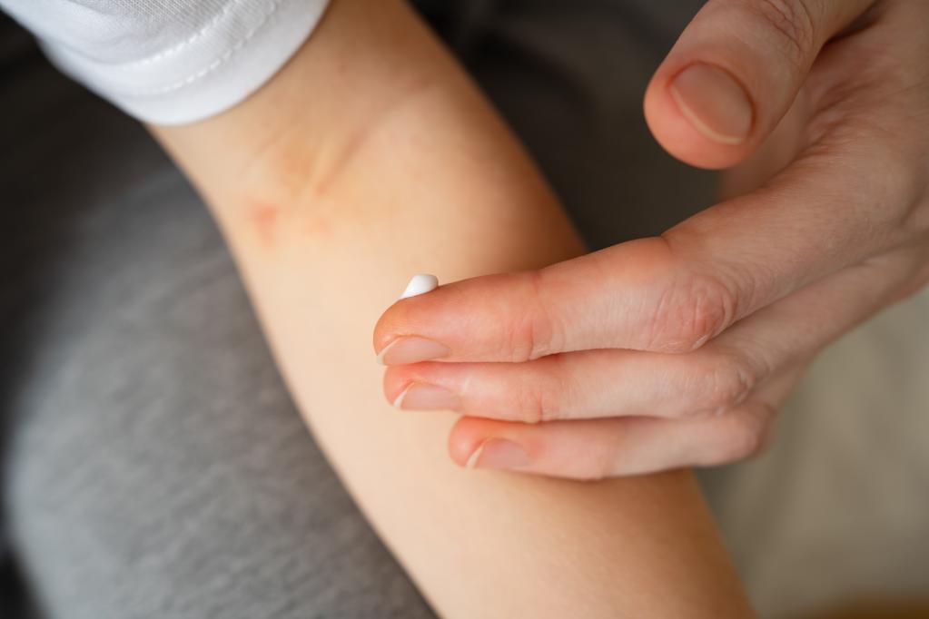 Child's arm with eczema with a mother applying cream to the skin