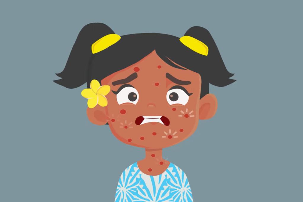 Stillshot from an animation about measles showing a child with measles