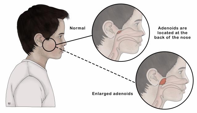 Illustration of a child’s profile showing the location of adenoids at the back of the nose, with two close-up views: one depicting normal adenoid size and another showing enlarged adenoids.
