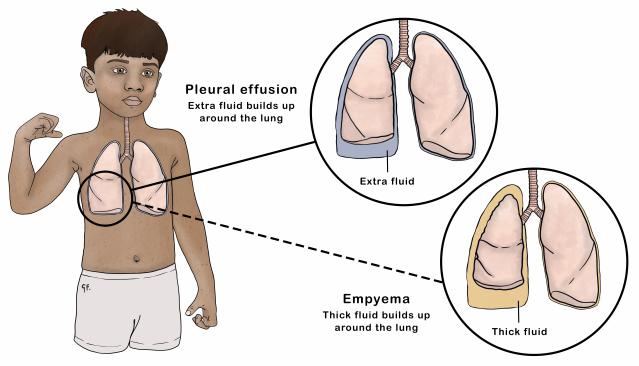 Illustration of a child showing normal lungs with an inset showing lungs with pleural effusion compared with lungs with empyema.