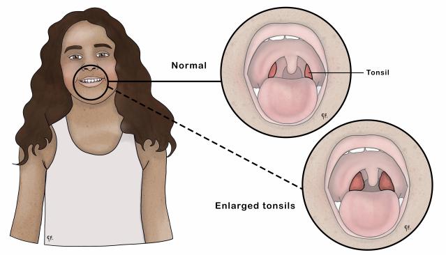 Illustration of a young girl with two circular insets showing the inside of her mouth. One inset labeled "Normal" displays normal-sized tonsils, while the other inset labeled "Enlarged tonsils" shows enlarged tonsils.