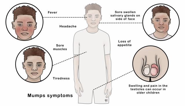 Illustration of mumps symptoms in a young child, showing fever, headache, sore swollen salivary glands on the side of the face, sore muscles, tiredness, and loss of appetite. An inset view highlights that swelling and pain in the testicles can occur in older children.