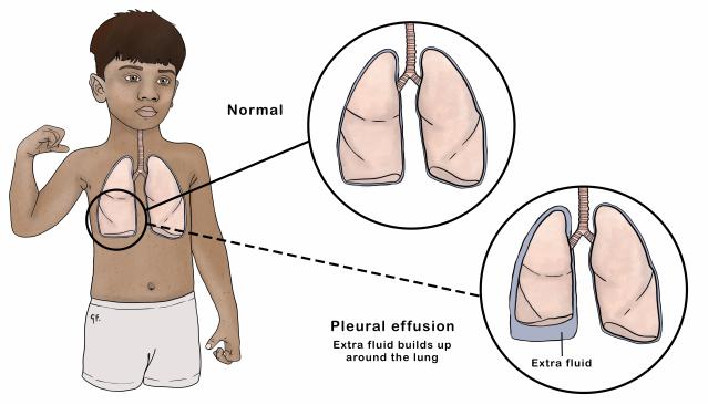 Illustration of a child showing normal lungs and lungs with pleural effusion. The normal lungs are shown on the left, while the right side shows lungs with extra fluid buildup around them, labeled as 'Pleural effusion.