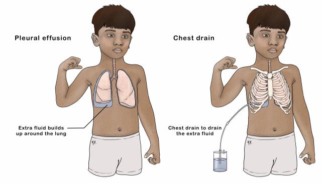Illustration of a child with pleural effusion in the left image, showing fluid buildup around the lung, and on the right, an image of the child with a chest drain inserted, connected to a container to remove the extra fluid from around the lung.