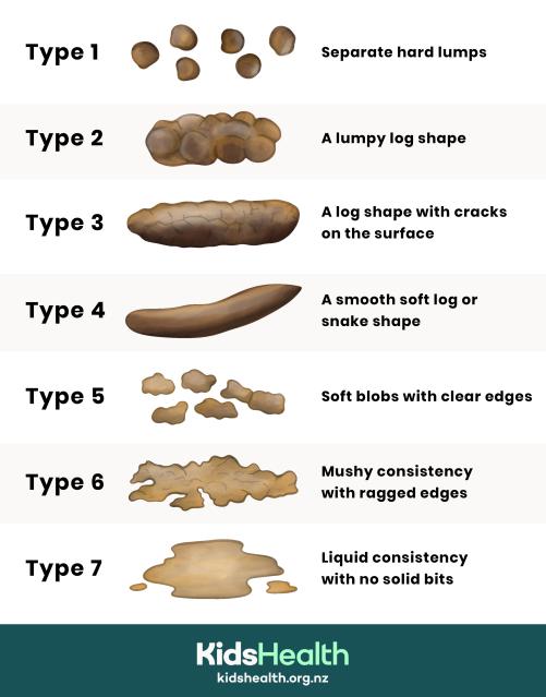 Adaption of a bristol stool chart showing the different types of stools with type and description.
