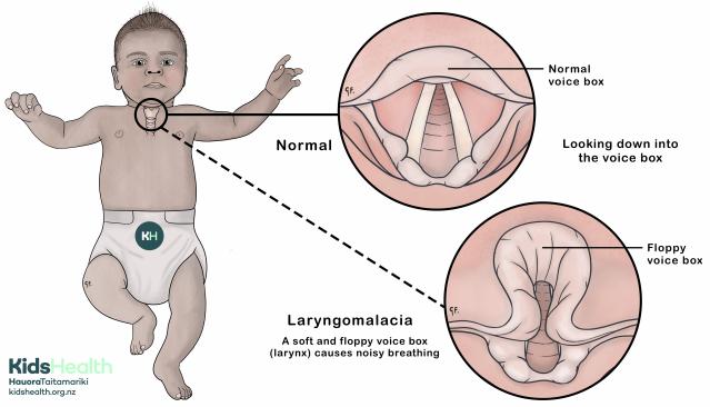 Illustration of a baby with a close up of their voice box comparing a normal upper airway to laryngomalacia