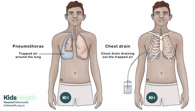 This illustration shows how a chest drain can treat a pneumothorax by removing trapped air from around the lung. One side shows a collapsed lung with air around it, and the other shows a chest drain in place with re-inflation of the lung.