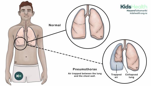 This illustration shows the difference between healthy lungs and a pneumothorax in a teenage boy. A pneumothorax happens when air gets trapped between the lung and chest wall, causing the lung to collapse.