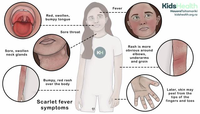 Illustration of a child showing the symptoms of scarlet fever
