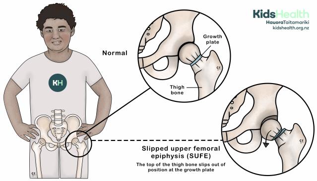 An illustration comparing the normal hip of a teenage boy to a hip with slipped upper femoral epiphysis or SUFE