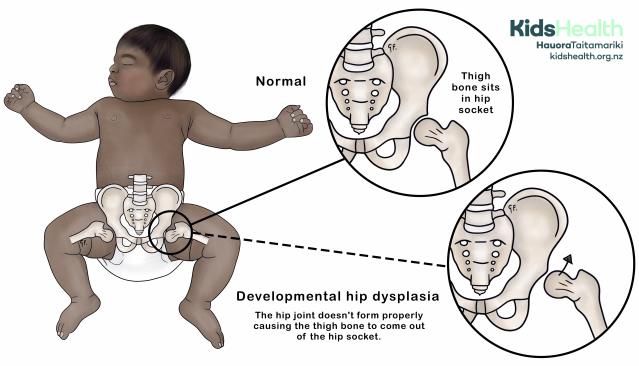 Illustration of a normal hip joint and developmental hip dysplasia in a baby