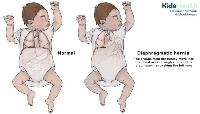 Illustration showing a baby with a diaphragmatic hernia and a small left lung compared with a baby with normal anatomy.