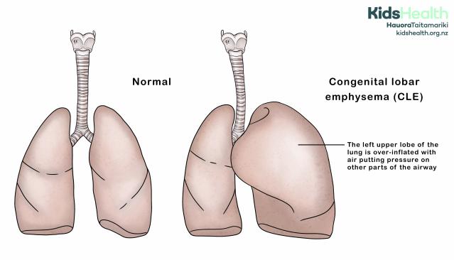 Illustration showing congenital lobar emphysema compared with normal lung anatomy. 