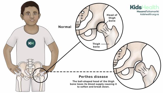 An illustration comparing a normal hip joint to a hip joint with Perthes disease