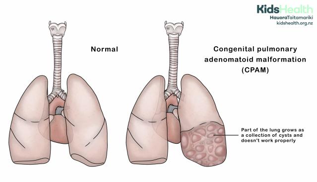 Illustration showing congenital pulmonary adenomatoid malformation compared with normal lungs