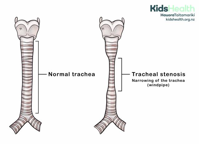 An illustration of tracheal stenosis compared with a normal trachea