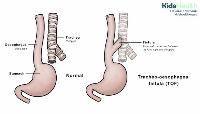 Illustration showing anatomy of a tracheo-oesophageal fistula compared with normal antaomy
