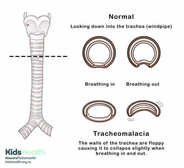 An illustration of tracheomalacia compared with a normal trachea, showing a cross-sectional view in inspiration and expiration.