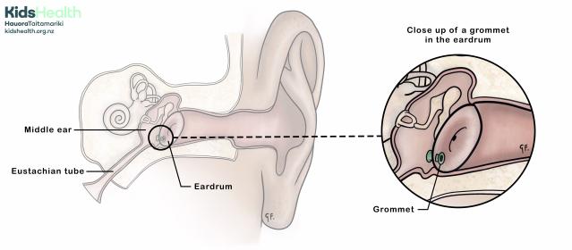 An illustration showing a side view of the ear with a grommet in place. A magnified circle shows a close-up view of the grommet sitting within the eardrum.