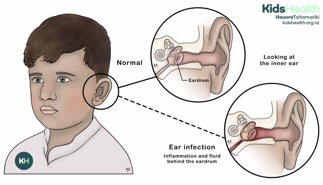 Illustration comparing a normal middle ear with a middle ear infection in a young boy