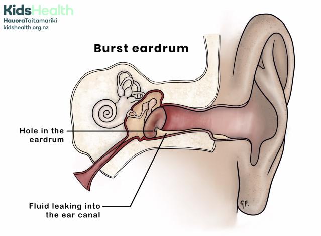 A side view illustration of an ear with a burst eardrum. The eardrum has a visible hole, and fluid is shown leaking from the middle ear into the ear canal.