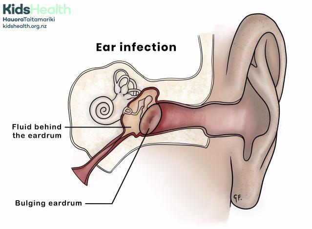 A side view illustration of an ear showing an ear infection. The middle ear space is red and swollen, with fluid buildup behind the eardrum, which appears bulging.