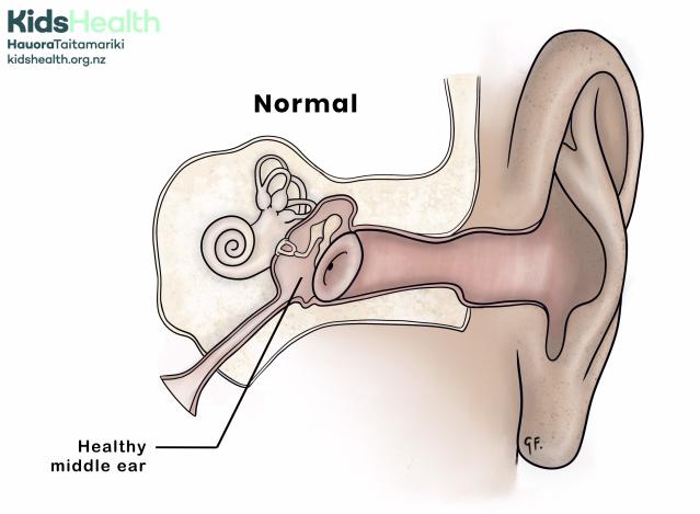 A side view illustration of the ear showing normal, healthy ear anatomy. The outer, middle, and inner ear structures are visible. The middle ear is clear and labelled “Healthy middle ear.”