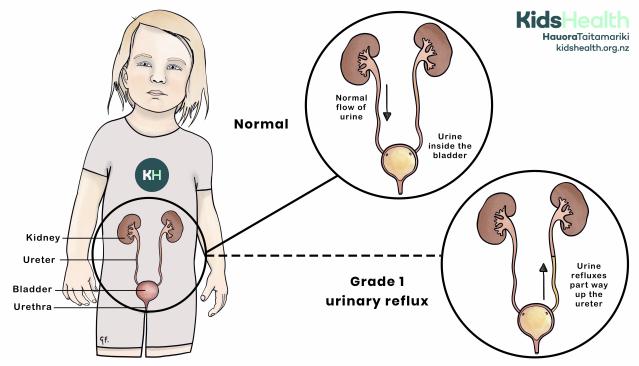 Illustration of a child showing the urinary tract, with a comparison between normal urine flow into the bladder and grade 1 urinary reflux, where urine flows partway back up the ureter.