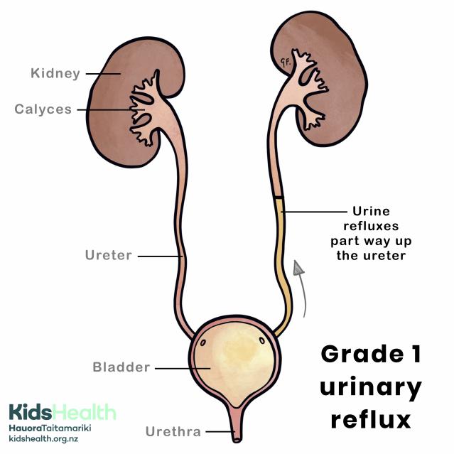 Diagram showing grade 1 urinary reflux