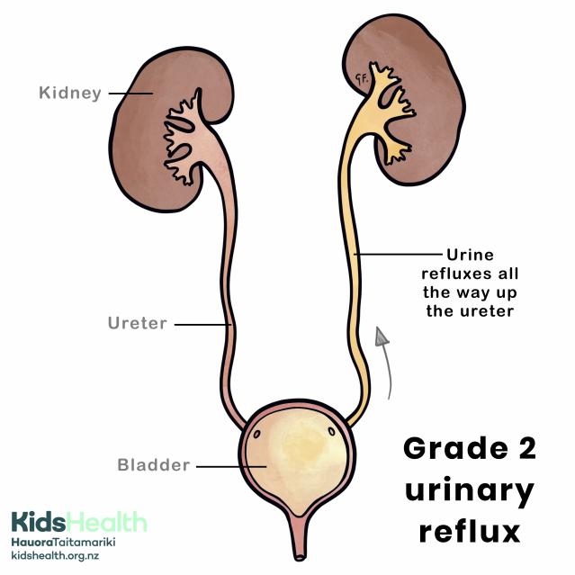 Grade 2 urinary reflux with genitourinary anatomy
