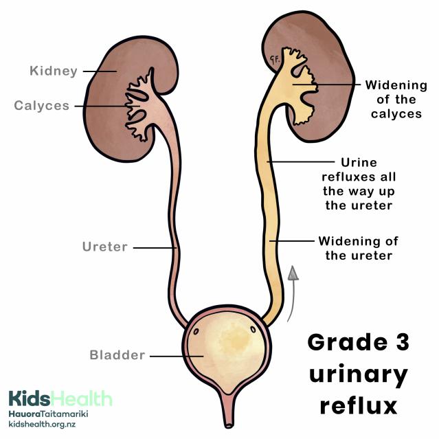Grade 3 urinary reflux with genitourinary anatomy