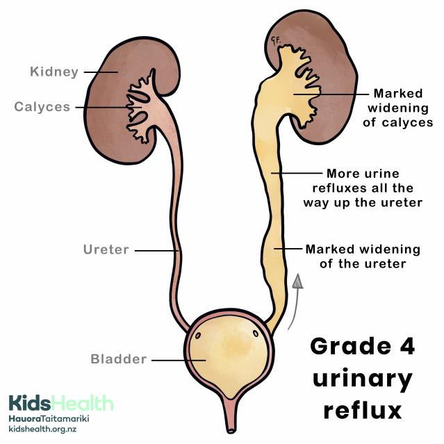 Grade 4 urinary reflux with genitourinary anatomy