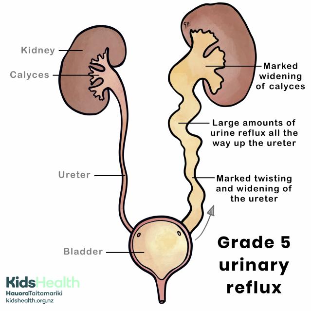 Grade 5 urinary reflux with genitourinary anatomy