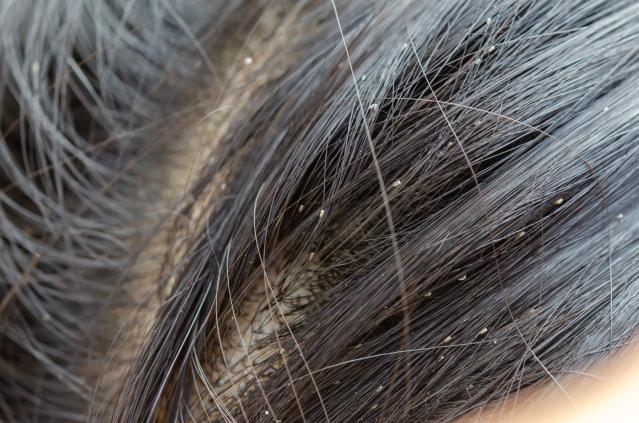 A photograph showing a close up view of a child's scalp and hair with head lice