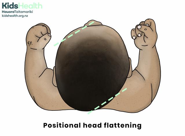 An illustration shows the top view of a baby’s head with flattening on one side, labeled "Positional head flattening." One side of the back of the head appears noticeably flatter than the other, creating an asymmetrical shape. Dashed green lines highlight the uneven head shape.