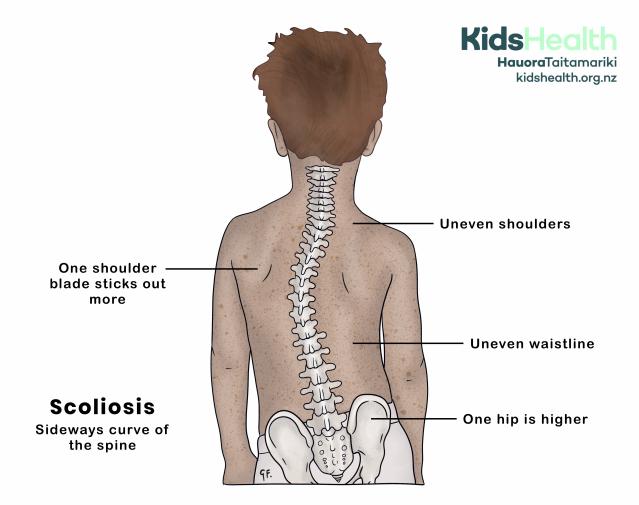 Illustration showing the visible physical signs in a young boy with scoliosis
