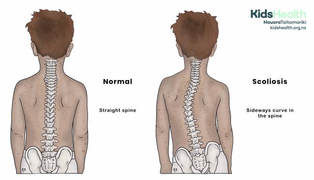 Illustration comparing a normal straight spine to a spine with scoliosis in a young boy