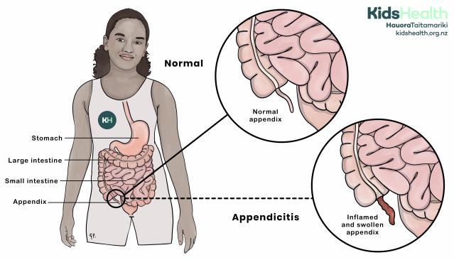 Illustration of a child showing the digestive system, with close-up diagrams comparing a normal appendix and appendicitis. The appendicitis diagram shows an inflamed and swollen appendix.