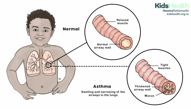 Illustration of a child showing a comparison between a normal airway and asthma. The normal airway has a relaxed muscle and clear passage, while the asthma airway shows tightened muscles, thickened airway walls, and mucus.