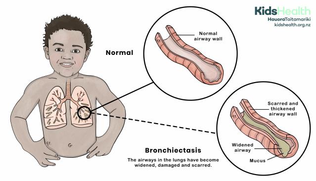 An illustration of a child with their lungs visible, showing a comparison between a normal airway and one affected by bronchiectasis. The normal airway is narrow with smooth walls, while the bronchiectasis airway is widened, scarred, and filled with mucus. Text explains that bronchiectasis causes damage and widening of the lung airways.