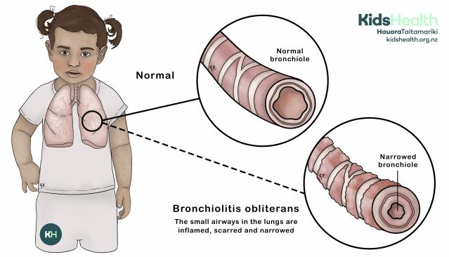 Illustration of a young child showing lungs, with close-up comparisons of a normal bronchiole and a narrowed bronchiole caused by bronchiolitis obliterans, a condition where the small airways in the lungs become inflamed, scarred, and narrowed.