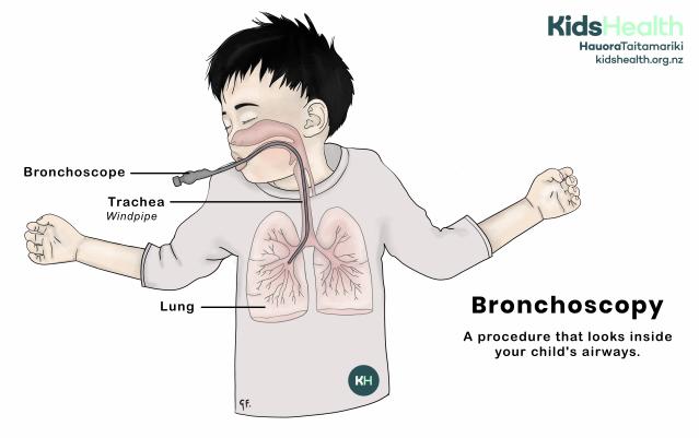 Illustration of a child showing how a bronchoscope goes through the mouth into the windpipe and lungs to look inside the airways.