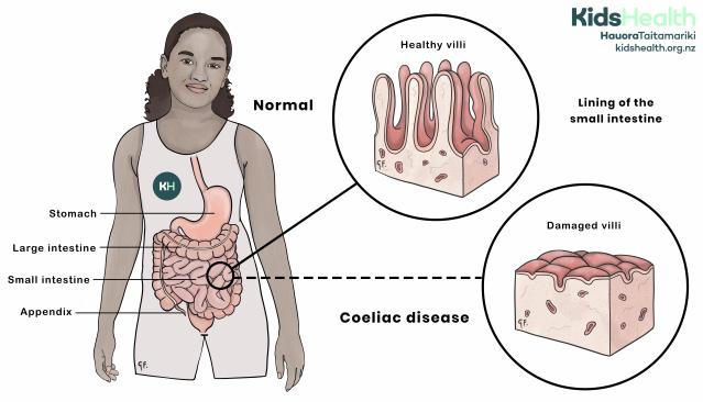 Image of a child showing small intestine changes in coeliac disease