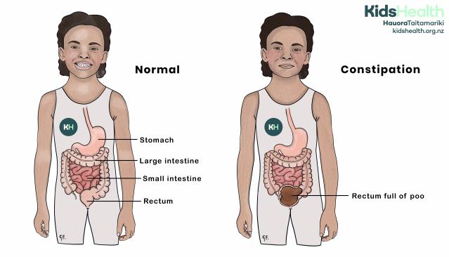 Illustration comparing a young child with a normal bowel and a child with a full rectum secondary to constipation