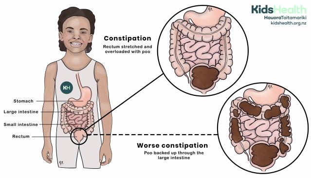 Illustration of a child with a normal digestive system and two close-up views of the intestines showing different stages of constipation. The first close-up shows constipation with the rectum overloaded with stool. The second shows worse constipation, with stool backed up through the large intestine. Labels identify the stomach, large intestine, small intestine, and rectum.